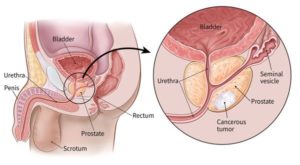 <img src=“what is prostate cancer” alt=“image describing what is prostate cancer”>