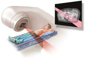 <img src=“radiotherapy” alt=“image showing radiotherapy”>